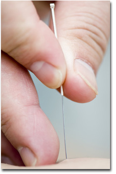 Vaincre le stress avec l'aide de l'acupuncture